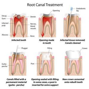 root canal