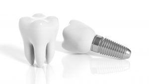 implant