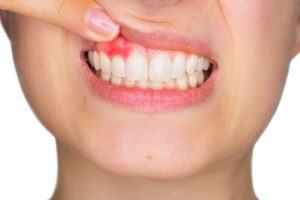 periodontal